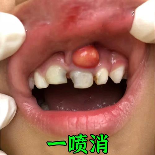牙龈脓包专冶牙根肿包牙根发炎肿包止痛消焱儿童牙龈肿痛消焱喷剂