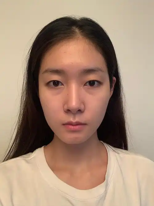 求美者天生的单眼皮,双眼无神略显呆滞