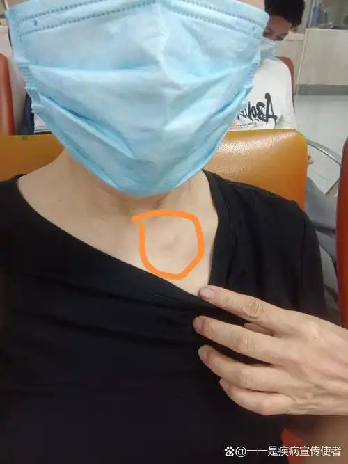 就锁骨右下侧凸出问题,今天去医院找专家看诊,专家医生说:没有问题,不