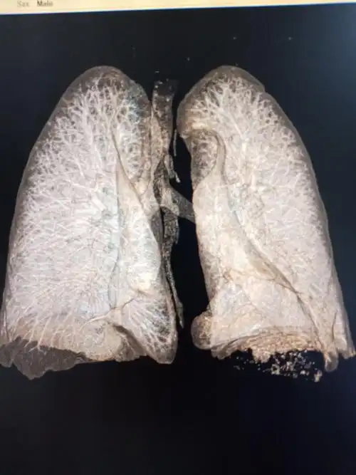 这项技术可以应用到肿瘤的肺叶定位,显示支气管异物