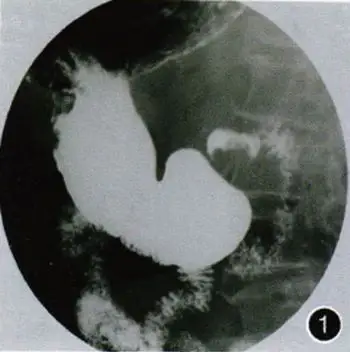 内镜黏膜下剥离术治疗胃黏膜脱垂症一例