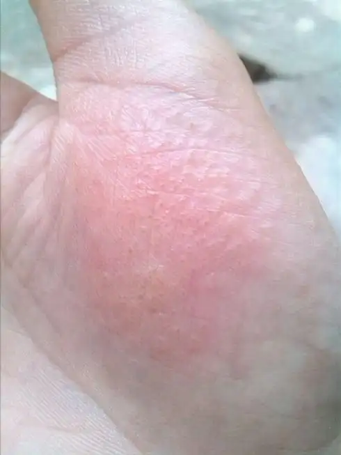 汗疱疹也被人们称为出汗障碍疹,本病是皮肤湿疹的一