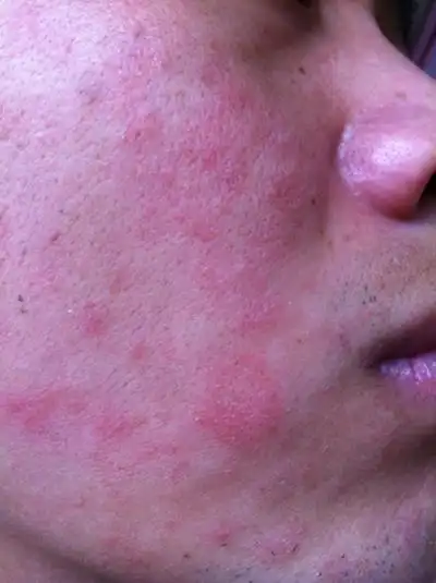 脸上长癣图片 (14)_有来医生