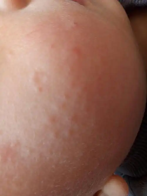 5,你好,宝宝屁股红考虑是湿疹,或者是尿布疹,这是宝宝的常见症状,只要