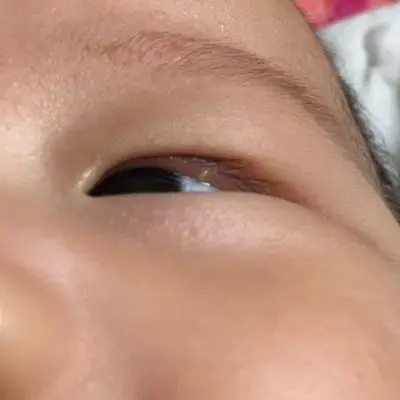 宝宝上眼皮长了个泡,有没有宝妈知道怎麼回事的?