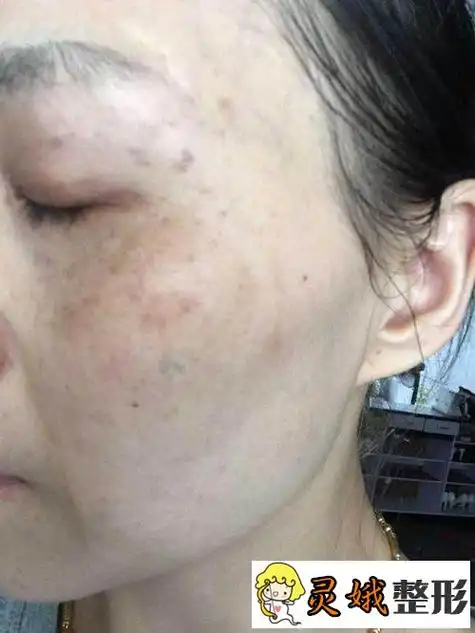 液氮祛斑为什么皮肤会反黑