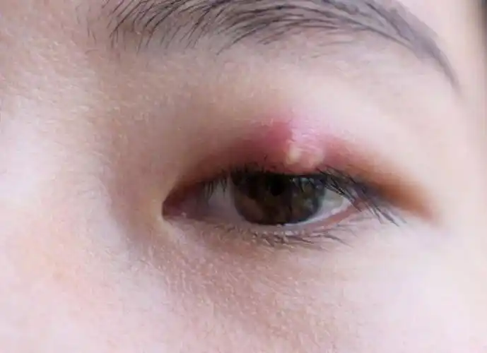 长了"针眼"(麦粒肿),怎样才能消的快?眼科专家支招_医生
