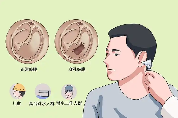 耳鼻喉科 是否医保: 是 英文名称:   tympanic membrane perforation