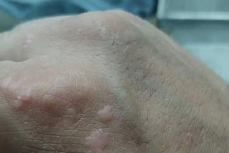 瘊子图片_有来医生