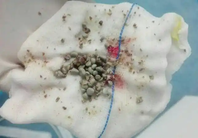 14岁孤儿腰腹部隐痛一查患右肾多发结石