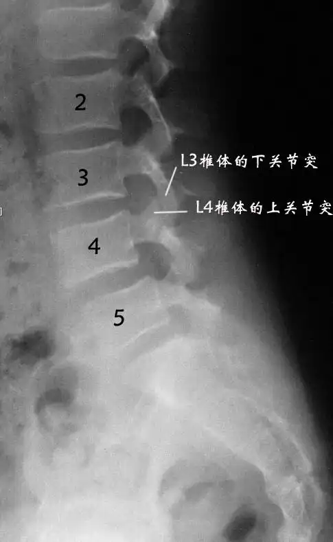峡部裂性腰椎滑脱