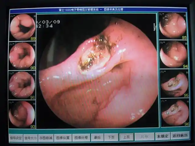 23岁女大学生命陨胃癌 该怎么预防 做胃镜!