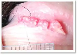 菜花(genitalwart) - 菜花 , 性病 , 人类乳突病毒 , hpv