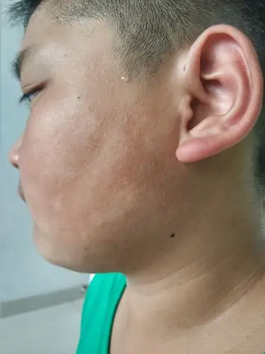 好多家长发现自己的孩子脸上出现了白斑,而且不止一片,不疼不痒.