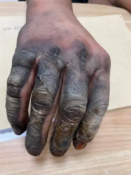 电击伤的特别多,6~9月高发月份,发生在农村地区的触电事故远高于城市