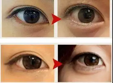 一分钟教你如何区分眼袋,卧蚕,泪沟!#广州伊站眼部护理