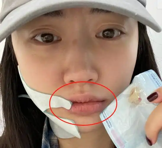 景甜拔牙后脸部肿一半牙齿上粘连血迹素颜双眼皮褶子不太自然