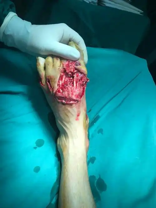 左足跖趾关节部不全离断伤