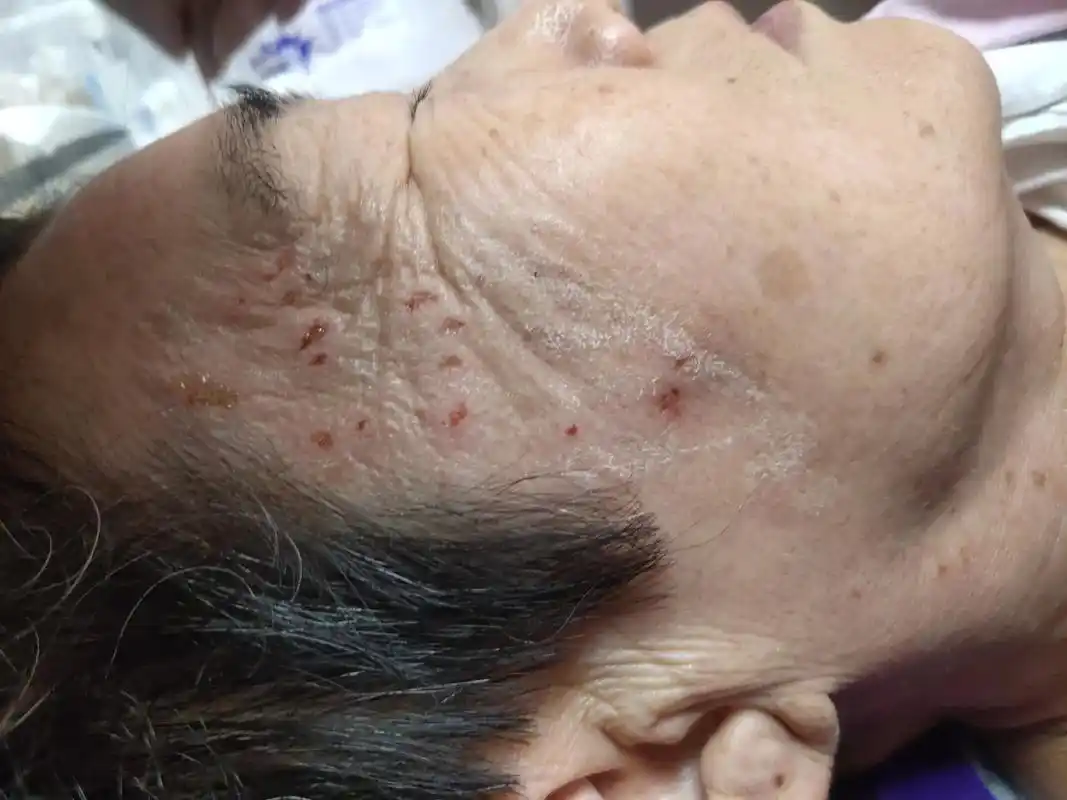 皮肤问题祛痣祛疣