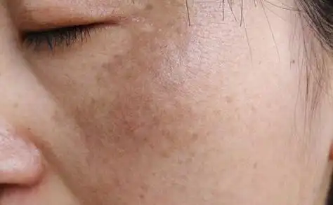 脸色暗沉发黑吃什么来调理好呢