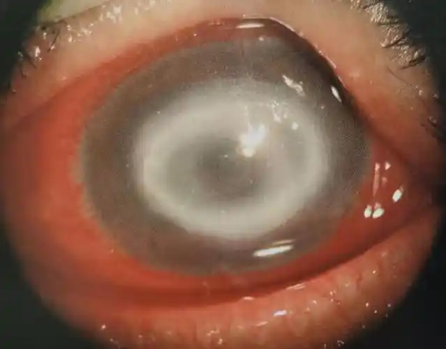 正常国人的角膜直径约为11-12mm,角膜越大既"黑眼球"越大,视觉上会