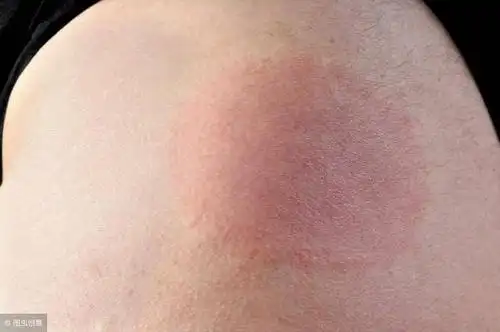 深部红斑狼疮饮食7大禁忌