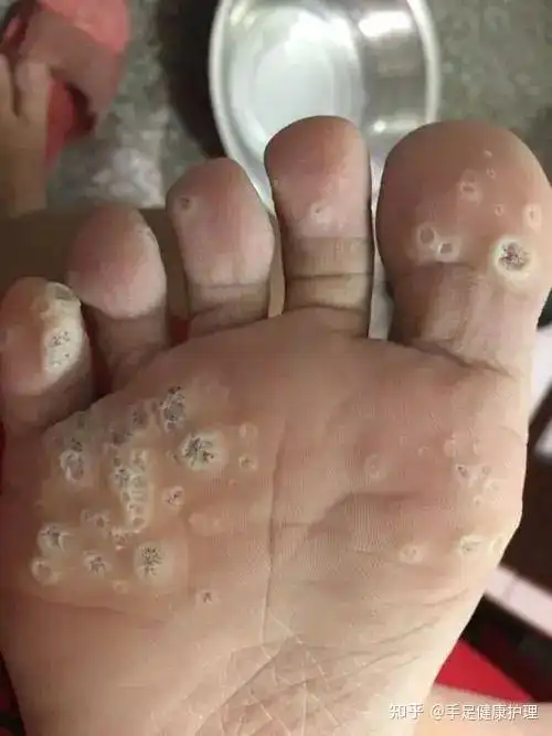 胼胝?鸡眼?跖疣?刺猴?傻傻分不清?