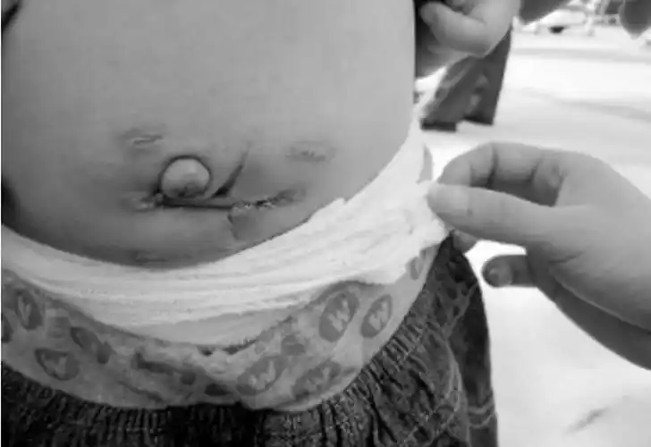 女孩小儿疝气症状图片