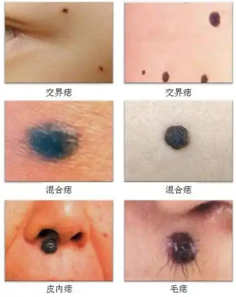 点痣 科谱对痣的认识#黑色素痣 #科普一下 - 抖音