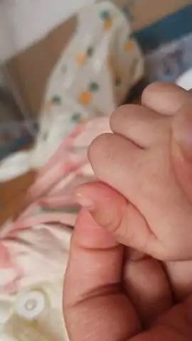 2个半月的宝宝手上起了个白疙瘩,哪位宝妈知道怎么回事吗?