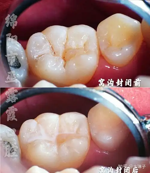 1,什么是窝沟封闭?