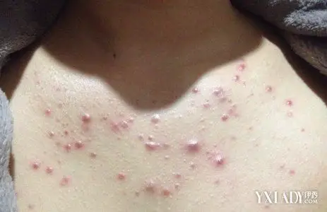 有没有人知道胸前长这种豆豆怎么处理 ?
