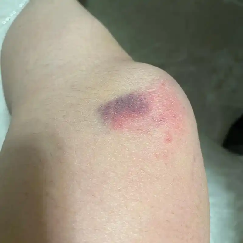 活着原来是多么一件幸运的事情啊……今天骑车摔在了