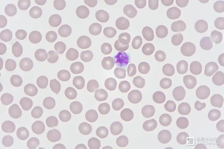 血小板何故如此低血涂片下见真章