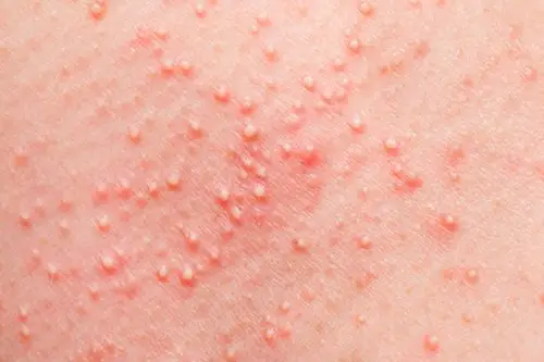 蚂蚁咬人后症状图片27