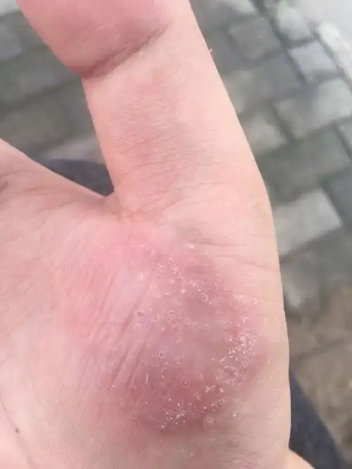 没有现在的照片吗 追问 只是右手的,有三四年了,反反复复 追答 是手癣