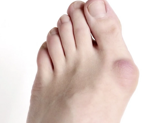 生活 日常 牛江红带您了解大脚骨原因  女生预防大脚骨的几个方法