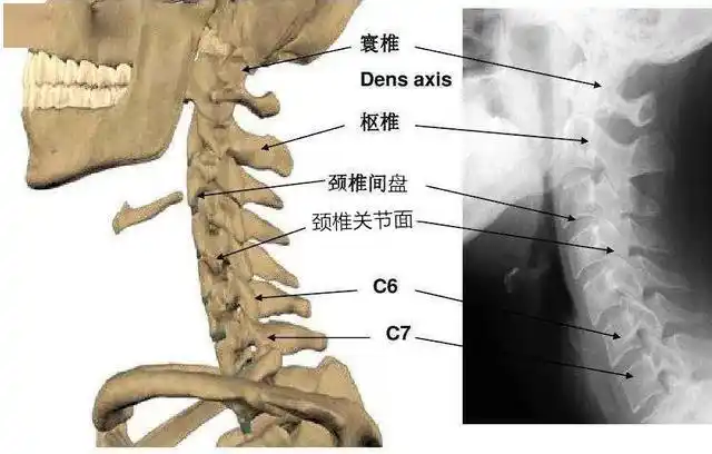 女孩脖颈疼痛剧烈虎妈误认为落枕检查却是寰枢关节半脱位
