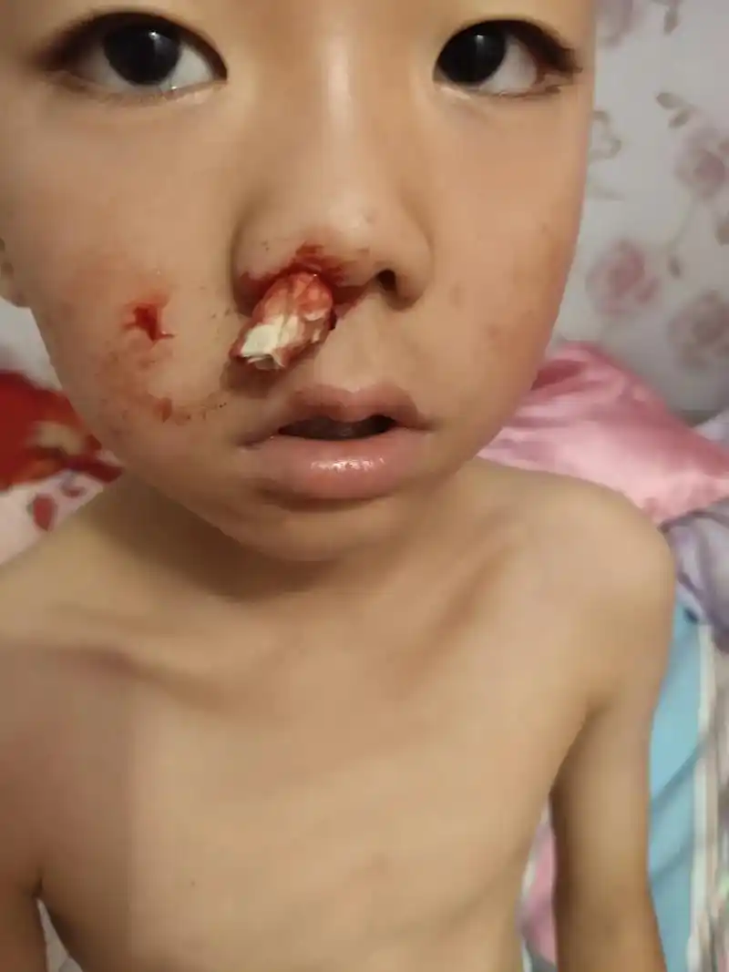 这几年儿子这个鼻出血,真让我操碎了心,每次都要把我给吓死,每 - 抖音