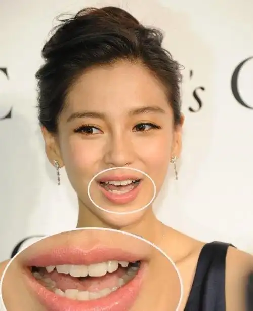 明星整牙整的最失败的一个angelababy做烤瓷牙老十岁