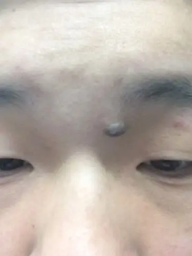 我这个痣算肉痣吗,可以去除吗