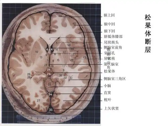 免费文档 所有分类 医药卫生 脑部断面解剖脑部断层解剖  详细 上一页