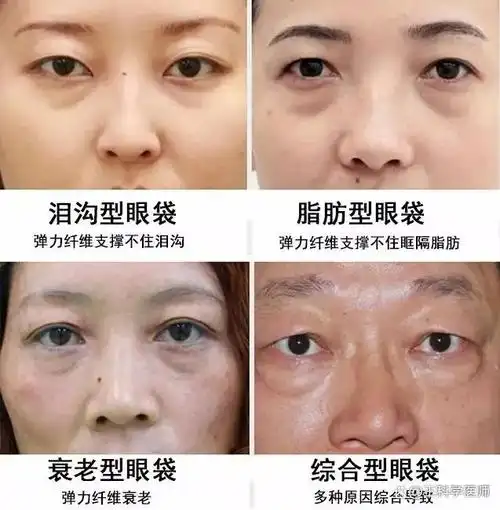 男士需要去眼袋吗?