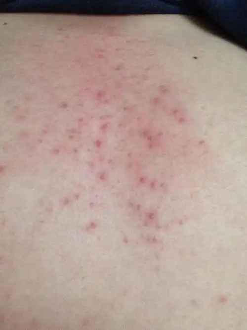 胸前长一片小红点,不痛不痒,3天了,什么病