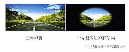 慢性闭角型青光眼早期症状较轻,或伴有眼胀头痛,视疲劳,虹视雾视等症