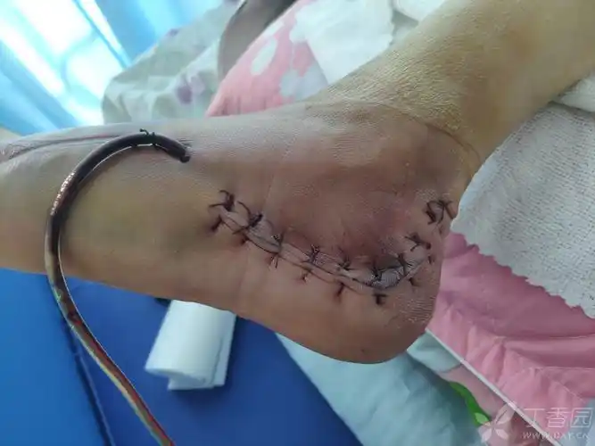 跟骨骨折手术术后第三天大家帮忙看看