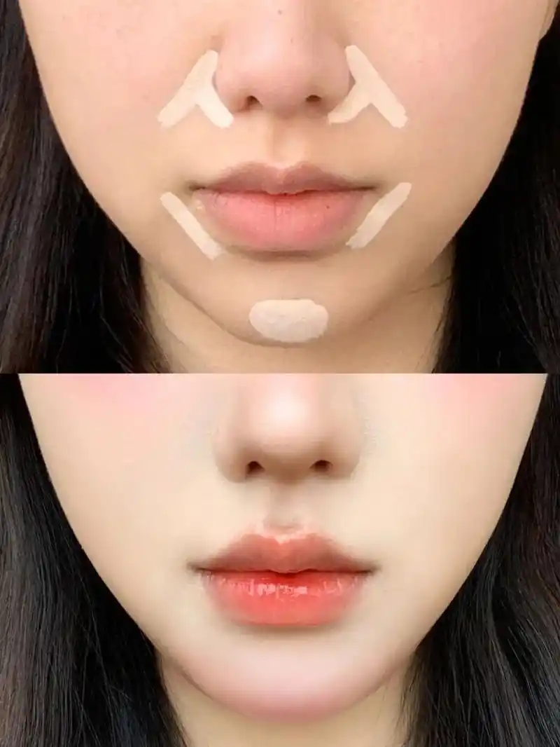 填充法令纹我悟了!改善嘴凸鼻基底凹陷.真的有变嫩变温柔!视觉 - 抖音