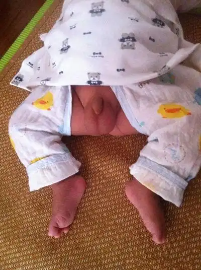 男宝宝疝气的症状图片52