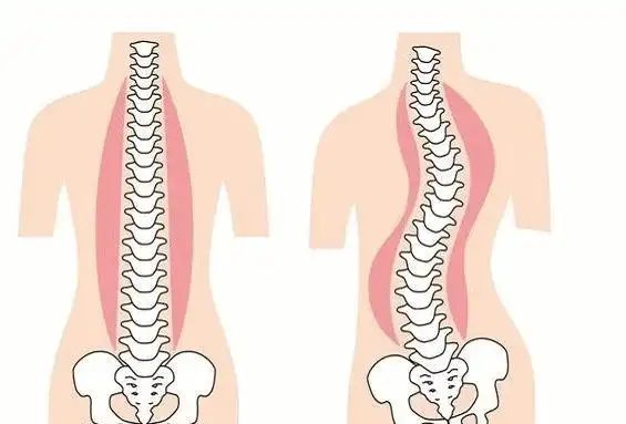 驼背(对,驼背可能是脊柱侧弯导致的),一侧肩胛骨突出,一侧肋骨突出