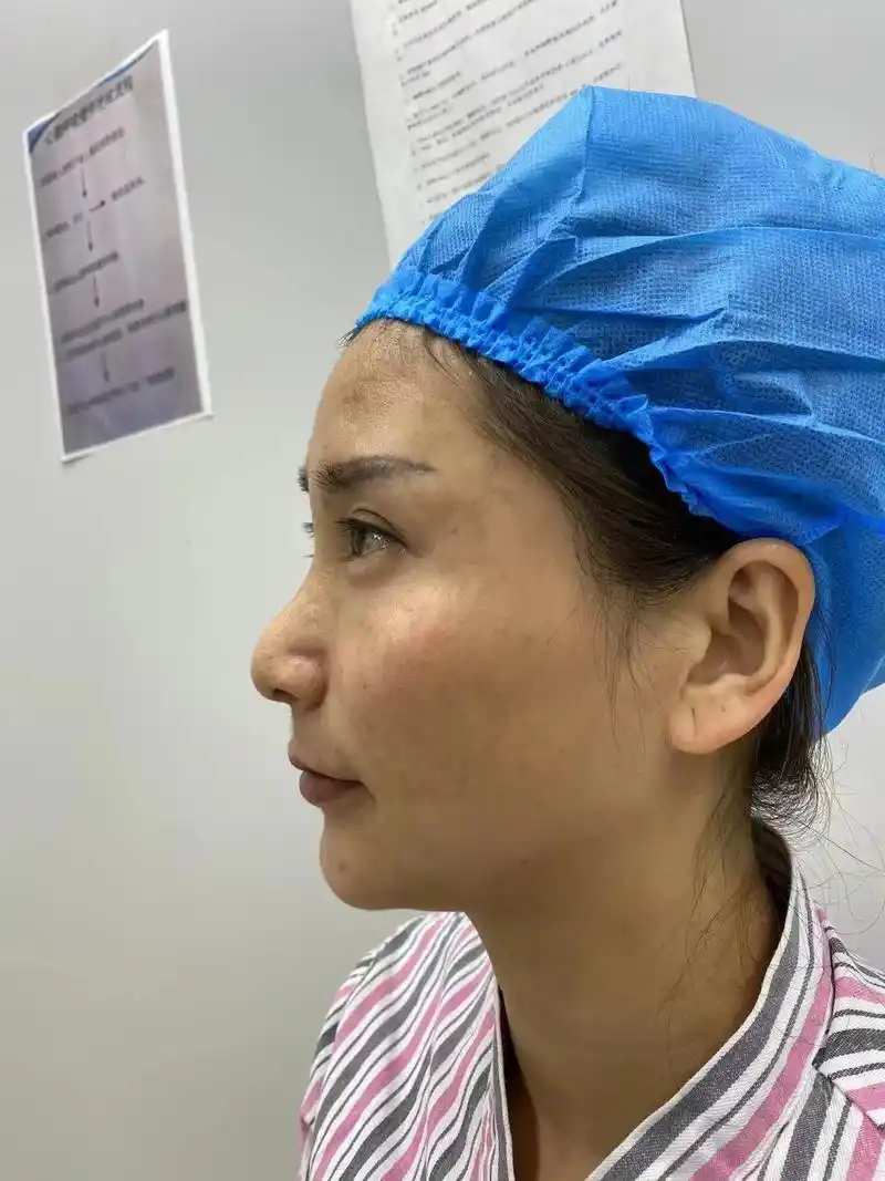 记录超肋鼻综合脱变.术前鹰勾鼻头,鼻孔畸形,采用自体肋骨在鼻 - 抖音